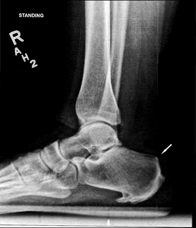 Lateral weight-bearing x-ray of right foot and ankle demonstrating Haglund’s deformity (arrow) of right calcaneus, a source of insertional Achilles tendenitis.